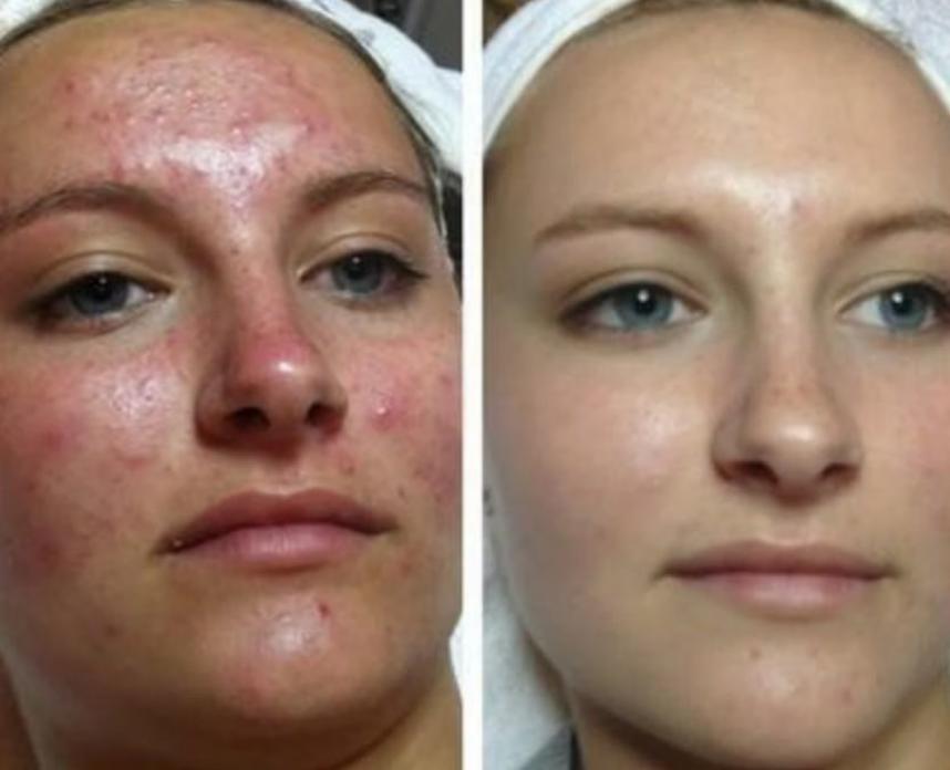 Active & inflammatory acne — 30 to 60 days — clinical case imagery