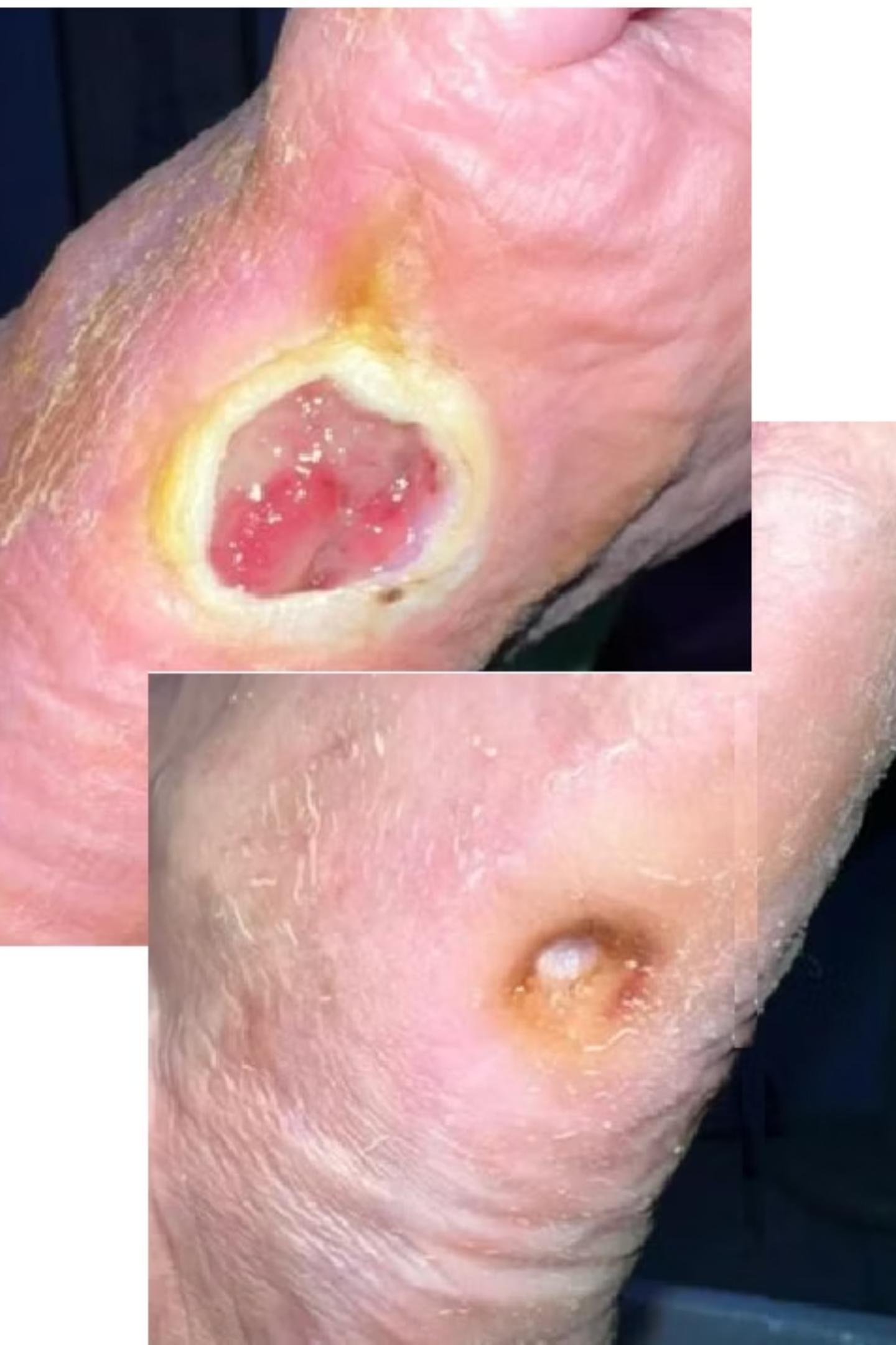 Diabetic foot ulcer — full closure in 36 days — clinical case imagery