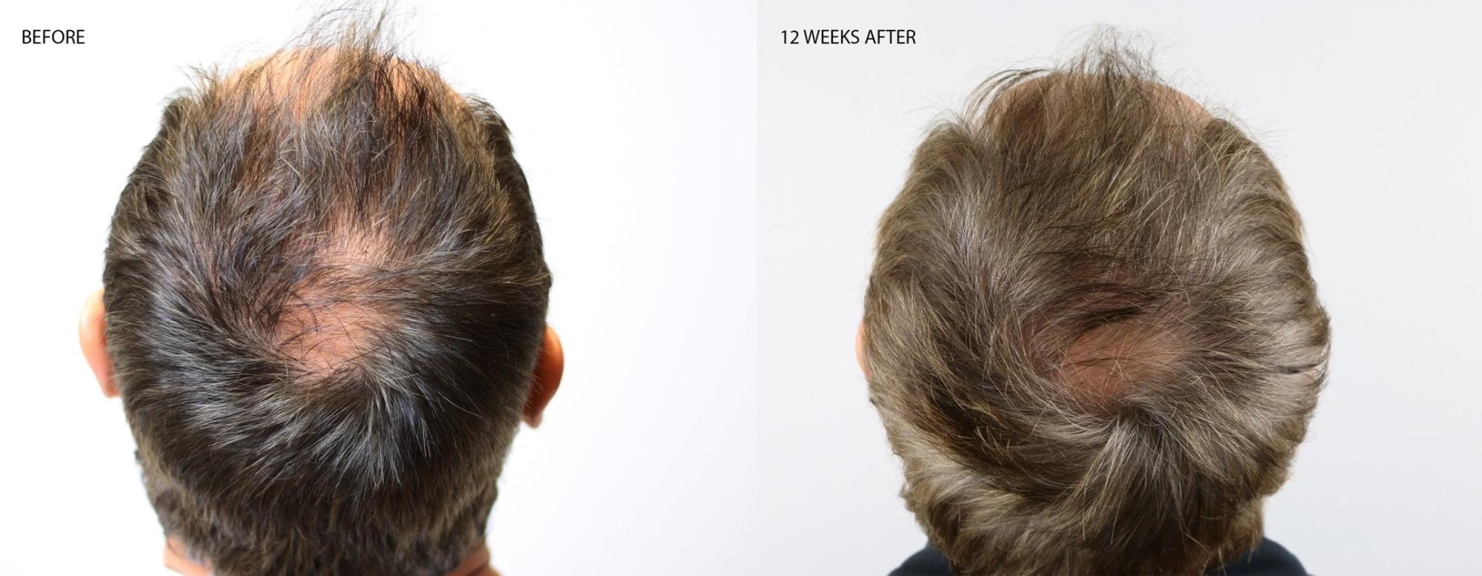 Hair restoration — 57-year-old male, 12 weeks — clinical case imagery