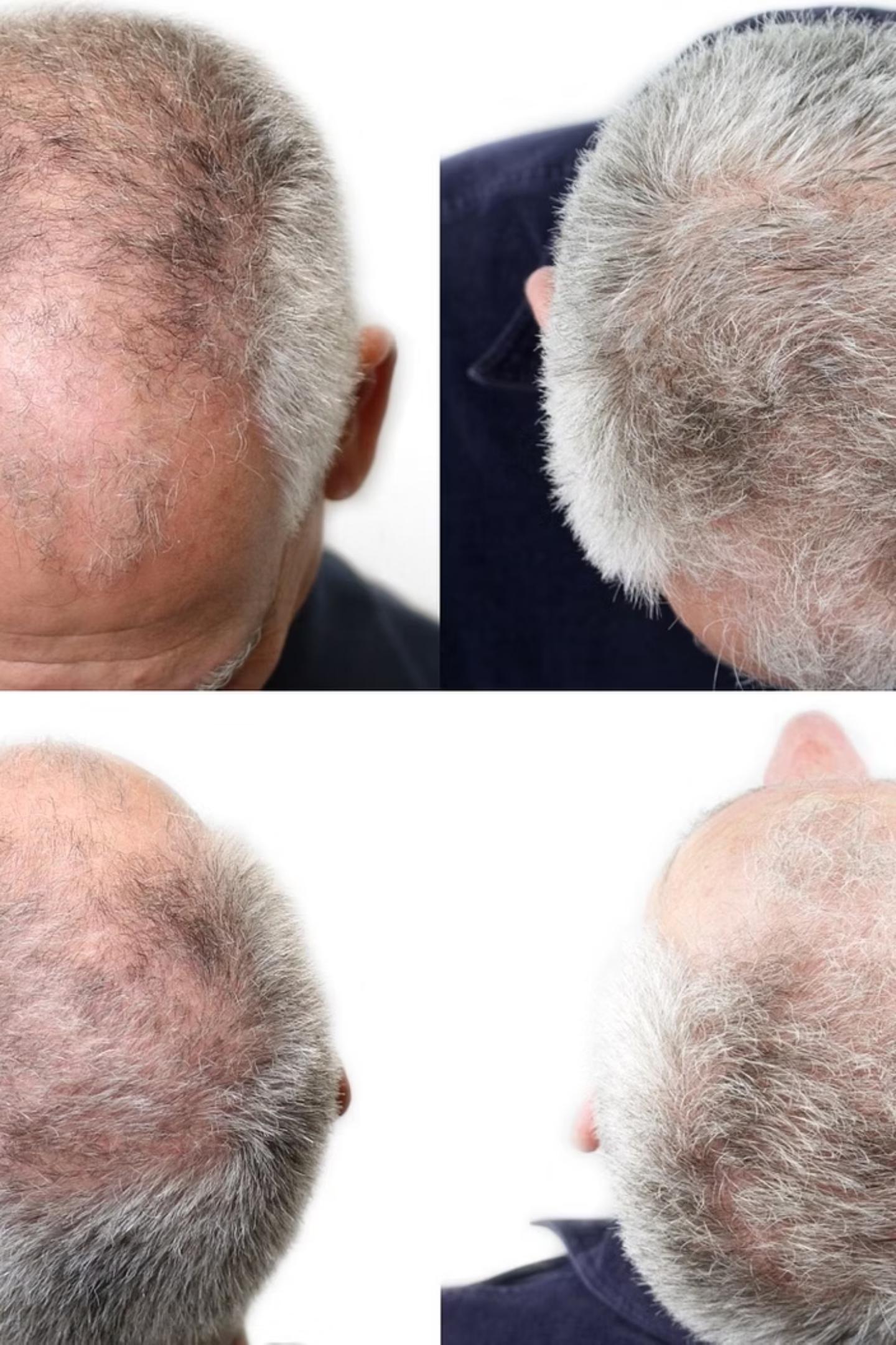 Hair restoration — 58-year-old male, 12 weeks — clinical case imagery