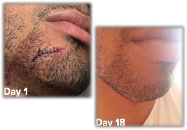 Hypertrophic & acne scar remodeling — clinical case imagery